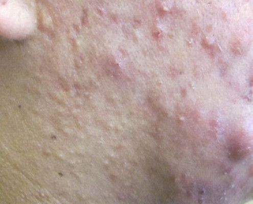 nodulocystic acne