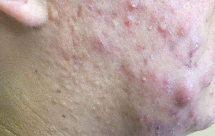 nodulocystic acne
