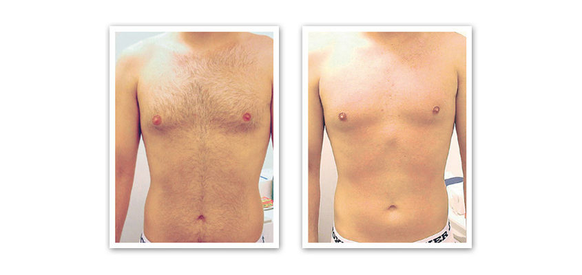 laser-hair-removal-results