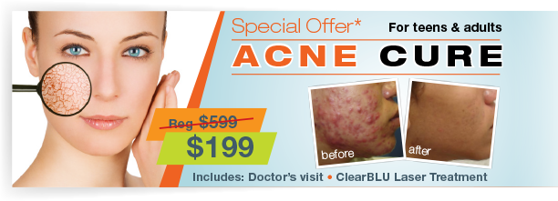 acne-cure-offer