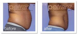 remove-belly-fat-without-surgery-for-men